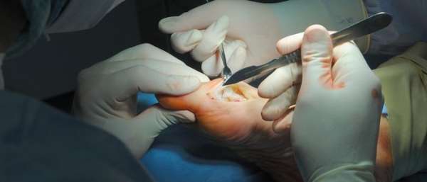 Операция по удалению косточки на ноге